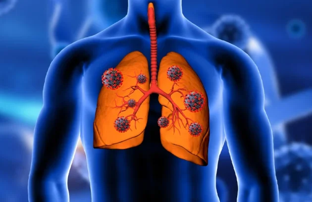 lung cancer specialist in ahmedabad