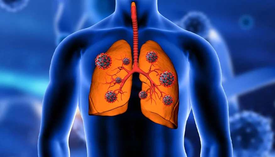 lung cancer specialist in ahmedabad