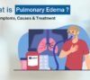 pulmonary edema