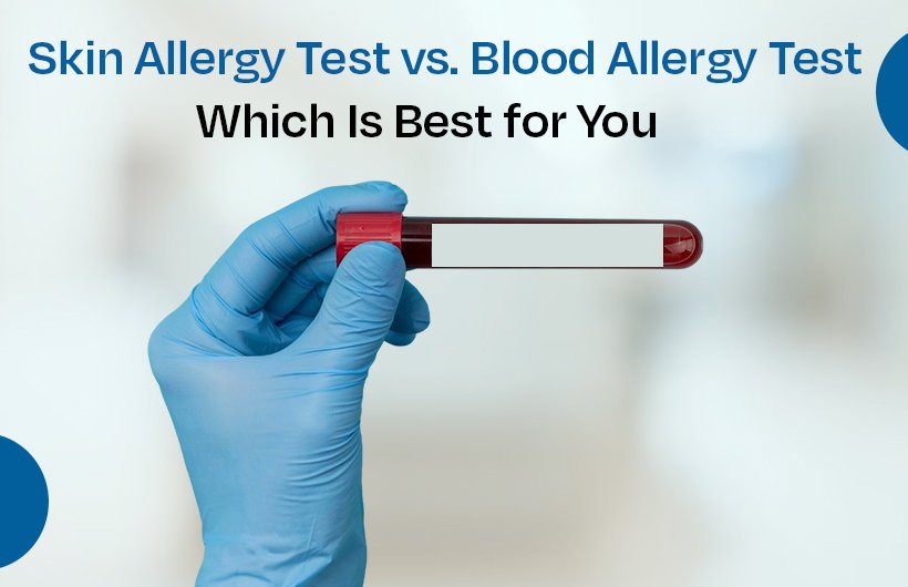 Skin Allergy Test vs. Blood Allergy Test: Which Is Best for You?