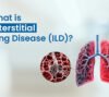 What Is Interstitial Lung Disease