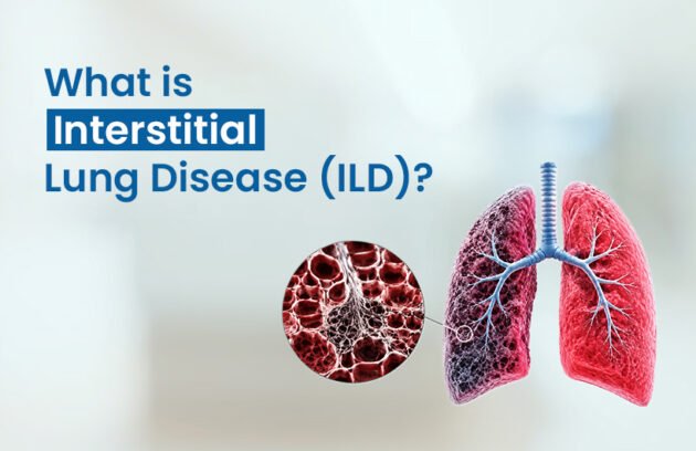 What Is Interstitial Lung Disease