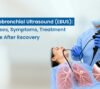 Endobronchial Ultrasound (EBUS)