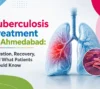 Tuberculosis Treatment in Ahmedabad