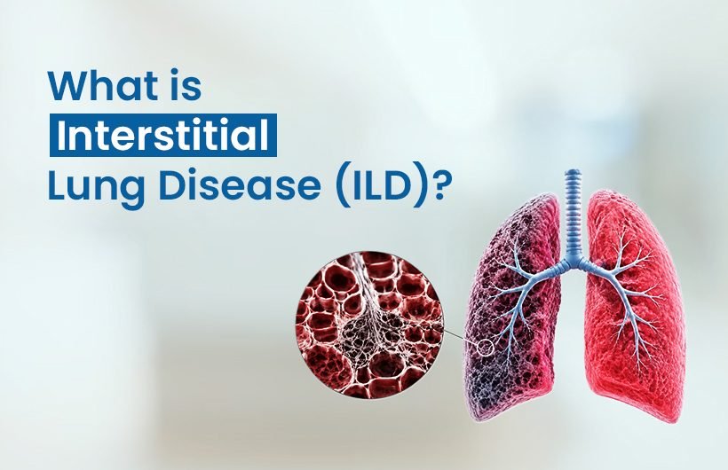 What Is Interstitial Lung Disease