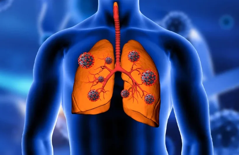 lung cancer specialist in ahmedabad