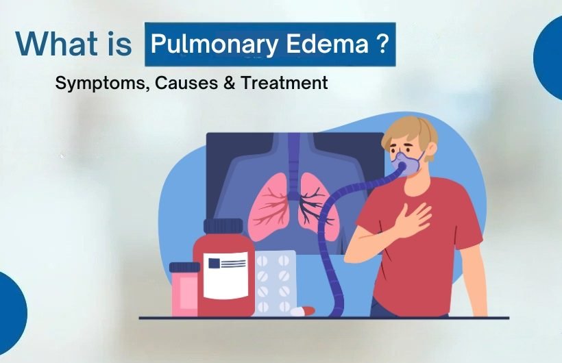 pulmonary edema